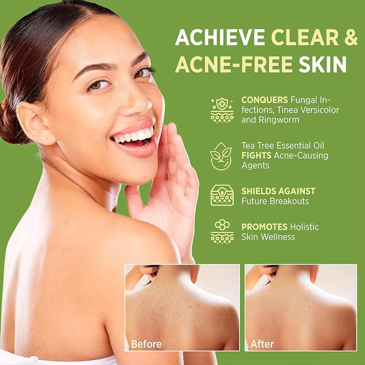 Custom Label Antifungal Tea Tree Soap Antibacterial Treatment for Face & Body Acne Herbal Soap Bar for Skin Soothing&Hydration