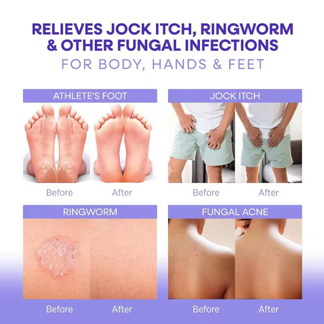 OEM Body&Face Wash Antifungal Soap Bar with Tea Tree Oil Lavender Oil Soothing Care & Relief of Itchy for Ringworm Jock Itch