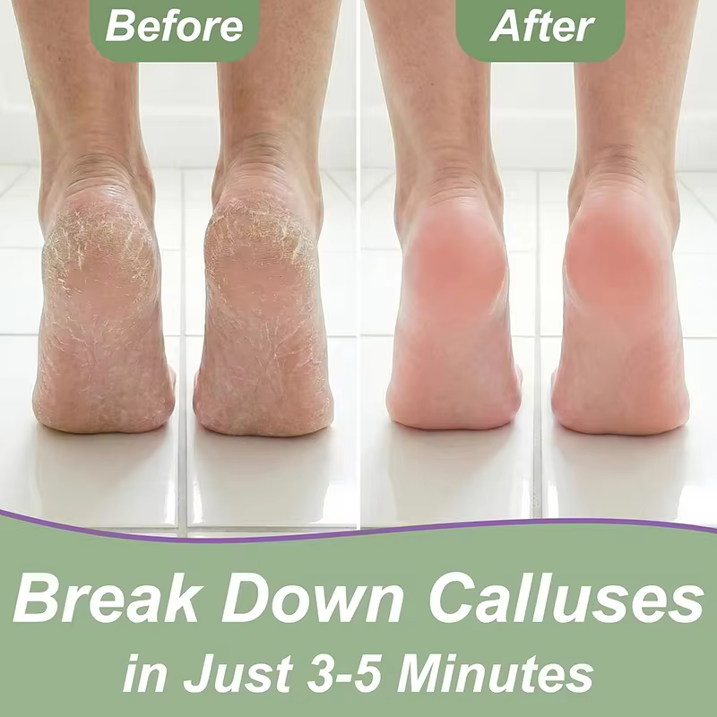 Custom Callus Remover Gel for Feet, Extra Strength Dead Skin Scrubber, Pedicure Tools Supplies, Foot Care Spa Kit