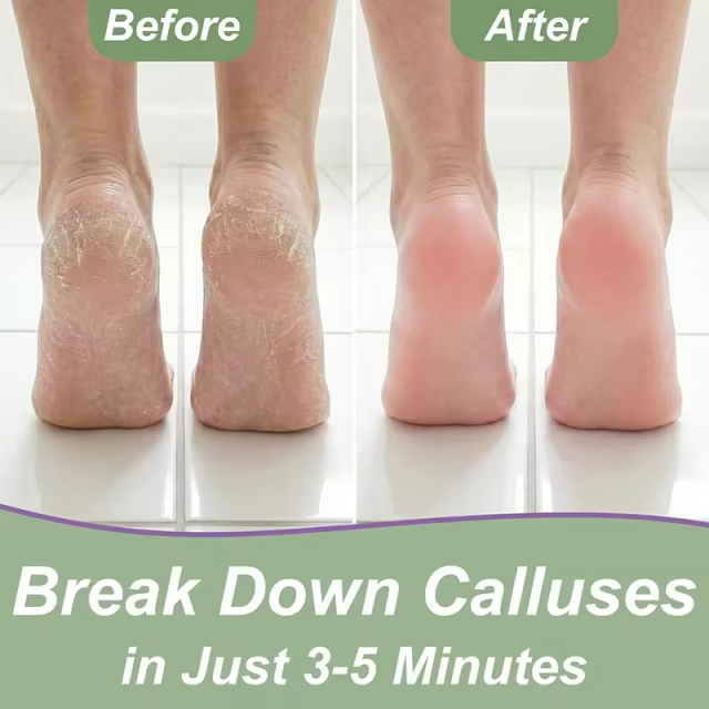 Custom Callus Remover Gel for Feet, Extra Strength Dead Skin Scrubber, Pedicure Tools Supplies, Foot Care Spa Kit
