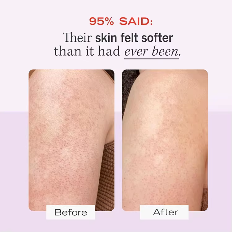 OEM KP Bump Eraser Body Scrub Mask for Keratosis Pilaris Skin Care Exfoliator Shower Scrub & Exfoliator for Sensitive Skin