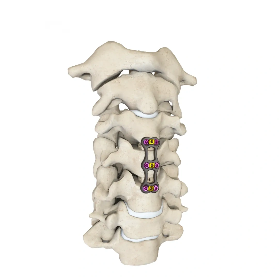 Anterior Cervical Plate - Type II,Shinvaunited,Anterior Cervical Plate - Type II