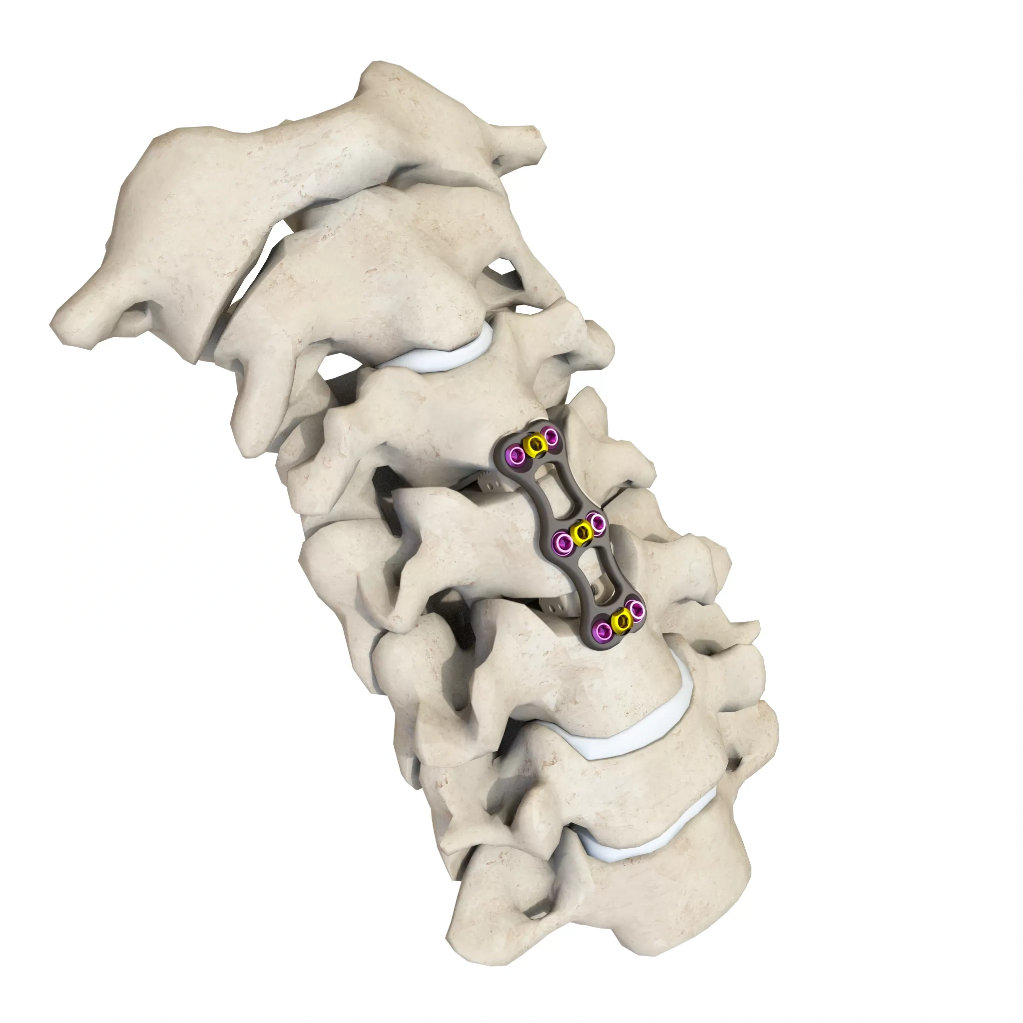 Anterior Cervical Plate - Type II,Shinvaunited,Anterior Cervical Plate - Type II