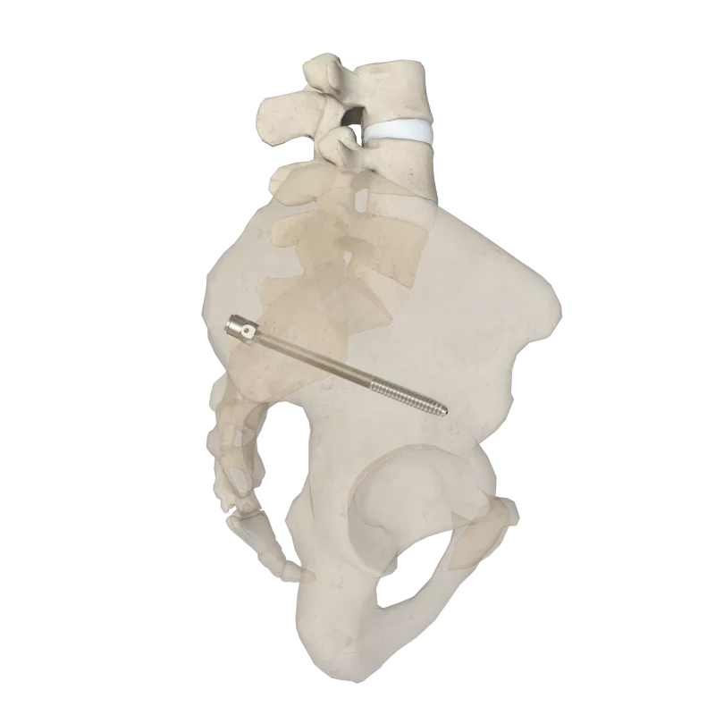 5.5 Thoracolumbar Percutaneous Screw & Rod System - Sacroiliac,Shinvaunited,5.5 Thoracolumbar Percutaneous Screw & Rod System - Sacroiliac