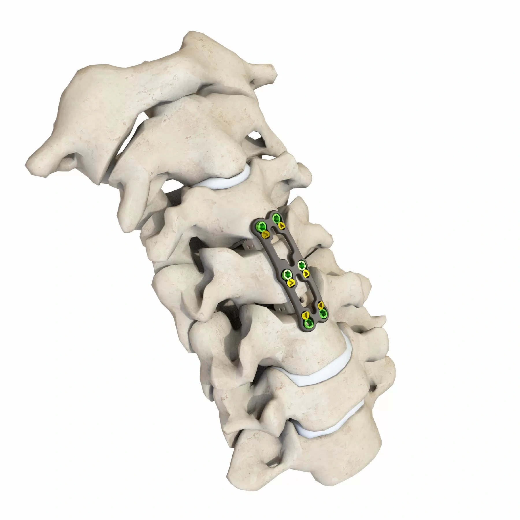 Anterior Cervical Plate – Type III,Shinvaunited,Anterior Cervical Plate – Type III