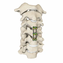 Anterior Cervical Plate – Type III,Shinvaunited,Anterior Cervical Plate – Type III