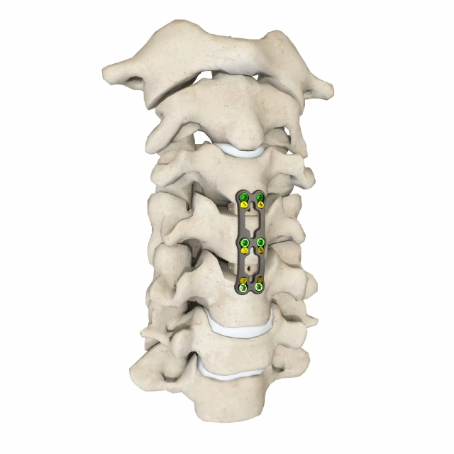 Anterior Cervical Plate – Type III,Shinvaunited,Anterior Cervical Plate – Type III