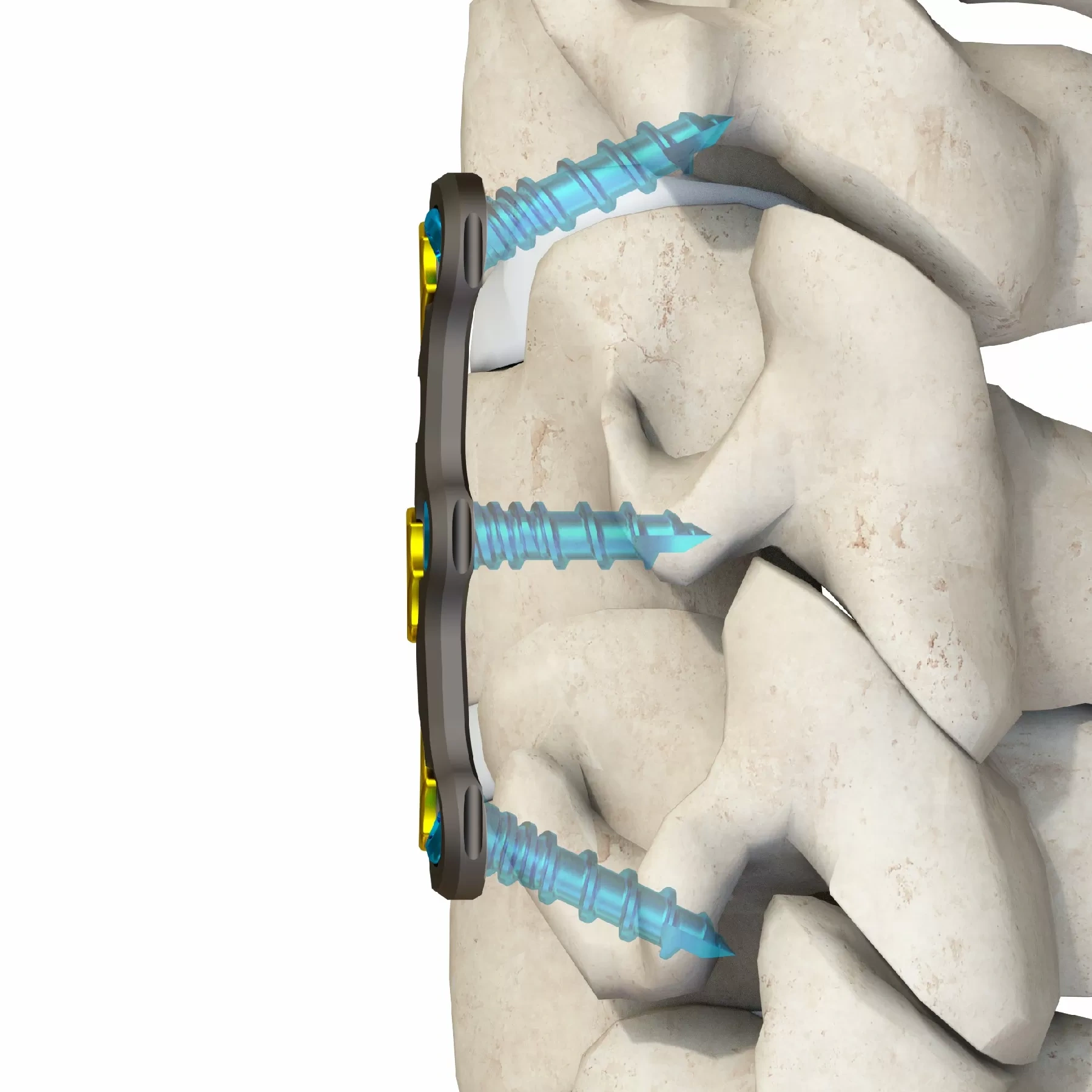 Anterior Cervical Plate – Type IV,Shinvaunited,Anterior Cervical Plate – Type IV
