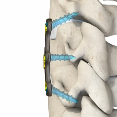 Anterior Cervical Plate – Type IV,Shinvaunited,Anterior Cervical Plate – Type IV