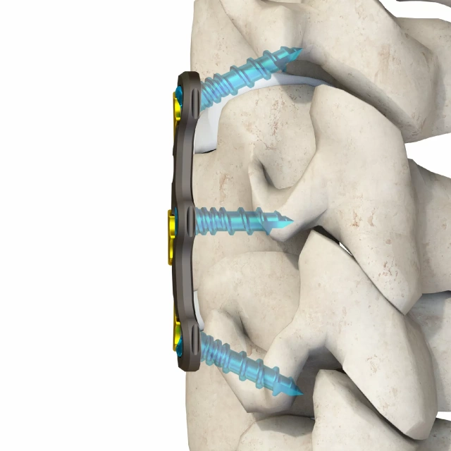Anterior Cervical Plate – Type IV,Shinvaunited,Anterior Cervical Plate – Type IV