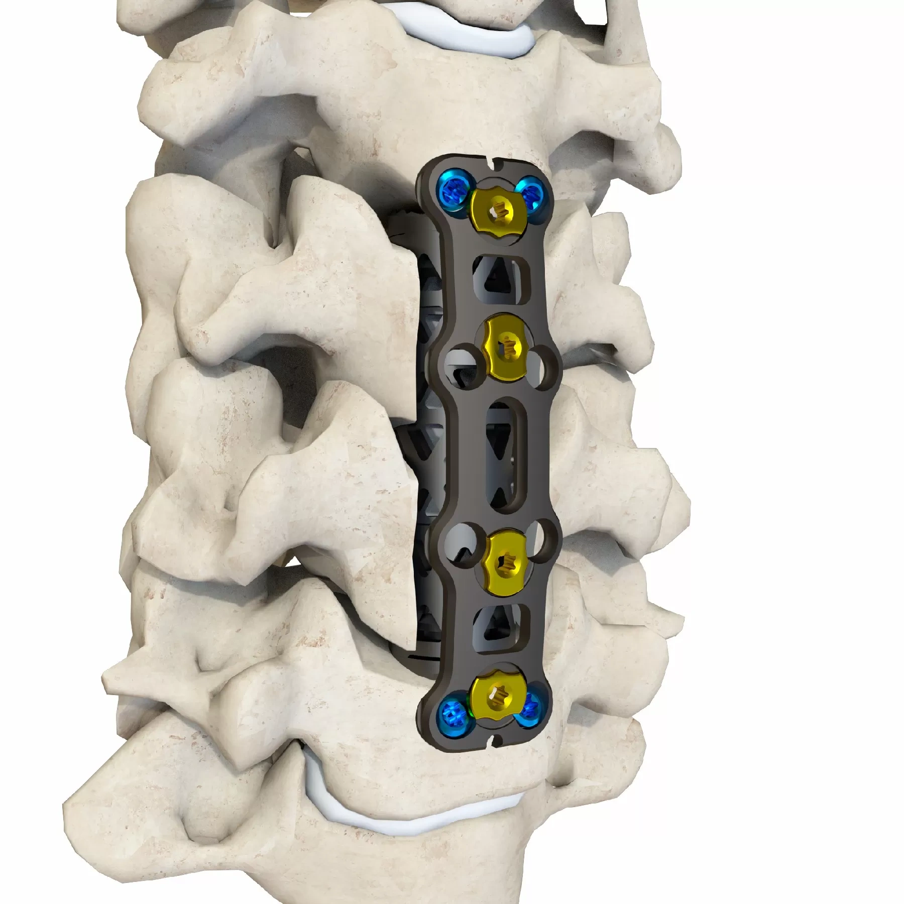 Anterior Cervical Plate – Type IV,Shinvaunited,Anterior Cervical Plate – Type IV