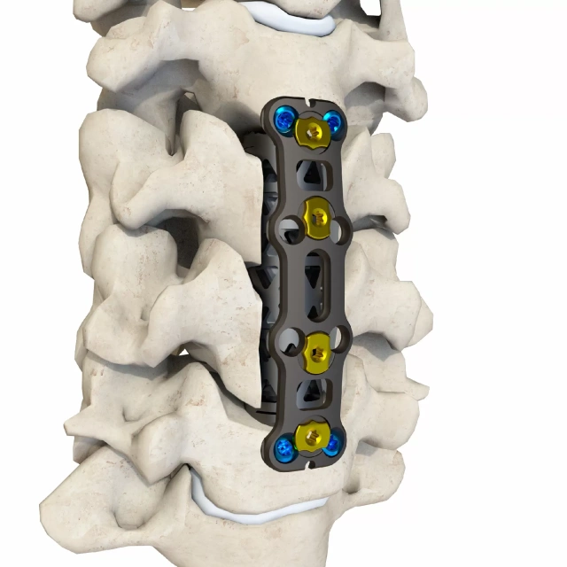 Anterior Cervical Plate – Type IV,Shinvaunited,Anterior Cervical Plate – Type IV