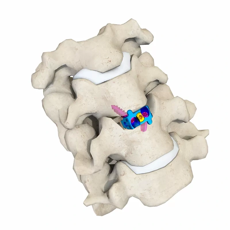 Cervical Interbody Fusion Cage (2 Screws),Shinvaunited,Cervical Interbody Fusion Cage (2 Screws)
