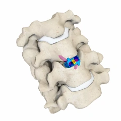 Cervical Interbody Fusion Cage (2 Screws),Shinvaunited,Cervical Interbody Fusion Cage (2 Screws)