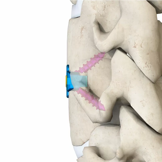 Cervical Interbody Fusion Cage (2 Screws),Shinvaunited,Cervical Interbody Fusion Cage (2 Screws)
