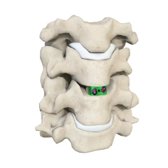 Cervical Interbody Fusion Cage (2 Screws),Shinvaunited,Cervical Interbody Fusion Cage (2 Screws)