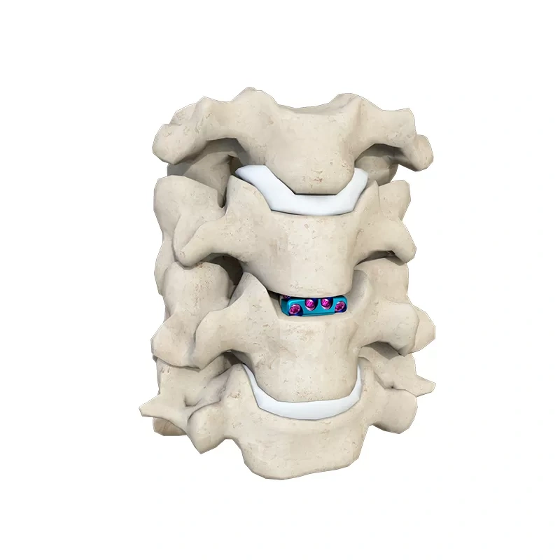 Cervical Interbody Fusion Cage (4 Screws),Shinvaunited,Cervical Interbody Fusion Cage (4 Screws)
