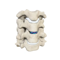 Cervical Interbody Fusion Cage (4 Screws),Shinvaunited,Cervical Interbody Fusion Cage (4 Screws)