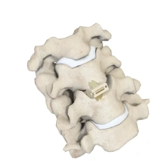 Cervical Interbody Fusion Cage (Insert-type),Shinvaunited,Cervical Interbody Fusion Cage (Insert-type)