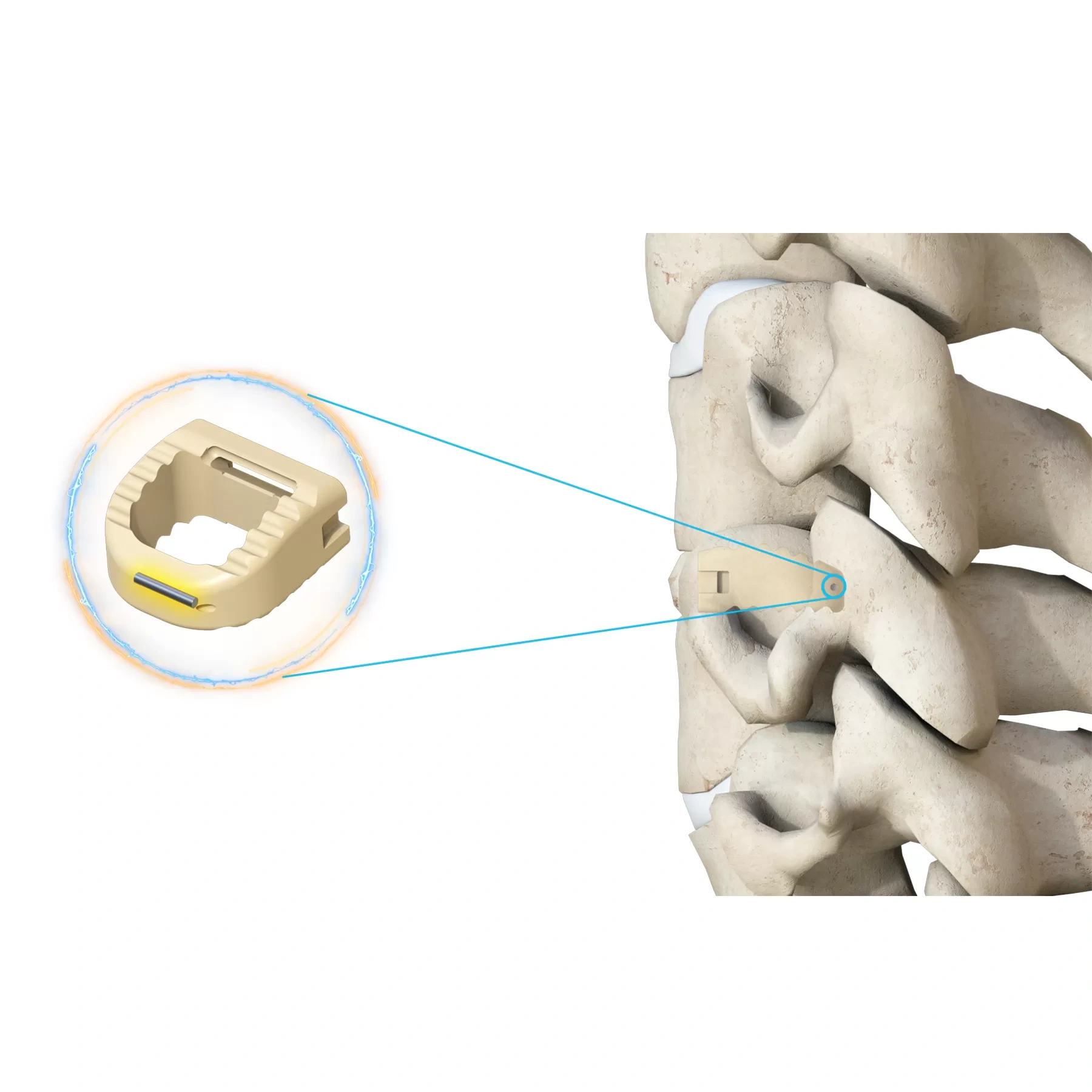 Cervical Interbody Fusion Cage (Insert-type),Shinvaunited,Cervical Interbody Fusion Cage (Insert-type)