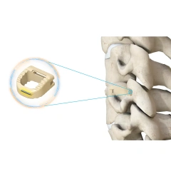 Cervical Interbody Fusion Cage (Insert-type),Shinvaunited,Cervical Interbody Fusion Cage (Insert-type)