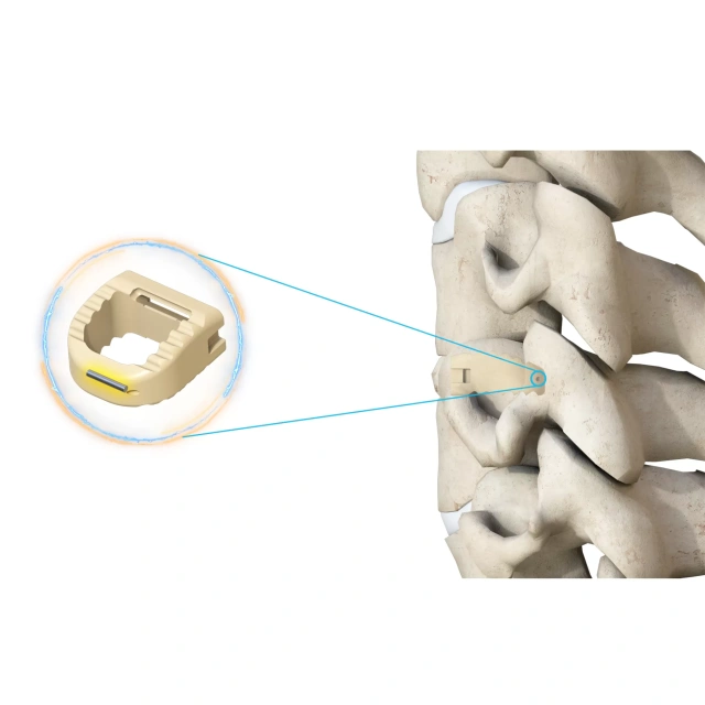 Cervical Interbody Fusion Cage (Insert-type),Shinvaunited,Cervical Interbody Fusion Cage (Insert-type)