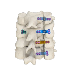 Hinged Titanium Laminoplasty Plate System,Shinvaunited,Hinged Titanium Laminoplasty Plate System