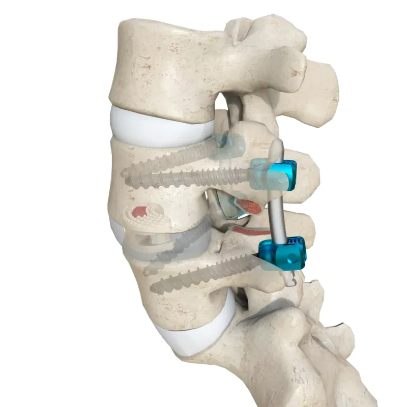 Kidney-Shaped Lumbar Interbody Fusion Cage LF-III,Shinvaunited,Kidney-Shaped Lumbar Interbody Fusion Cage LF-III