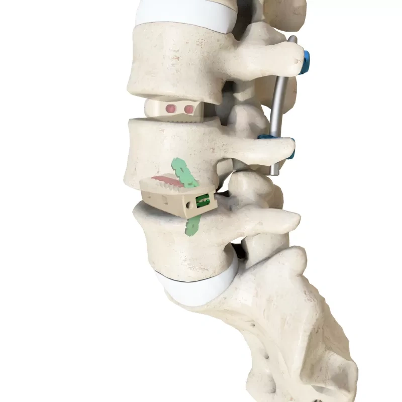 Lumbar Interbody Fusion Cage(Insert-Type),Shinvaunited,Lumbar Interbody Fusion Cage(Insert-Type)
