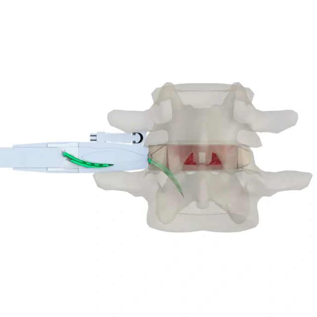 Lumbar Interbody Fusion Cage(Insert-Type),Shinvaunited,Lumbar Interbody Fusion Cage(Insert-Type)