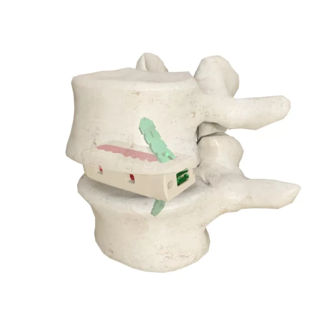 Lumbar Interbody Fusion Cage(Insert-Type),Shinvaunited,Lumbar Interbody Fusion Cage(Insert-Type)
