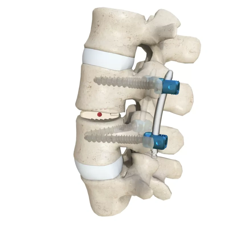 Lumbar Interbody Fusion Cage LF-I,Shinvaunited,Lumbar Interbody Fusion Cage LF-I