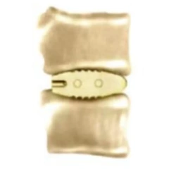 Lumbar Interbody Fusion Cage LF-I,Shinvaunited,Lumbar Interbody Fusion Cage LF-I