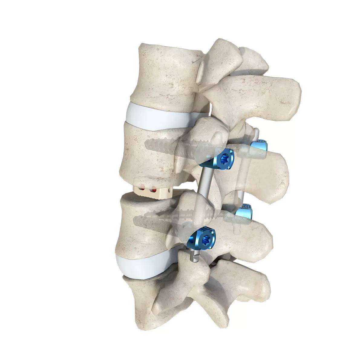 Lumbar Interbody Fusion Cage LF-II,Shinvaunited,Lumbar Interbody Fusion Cage LF-II