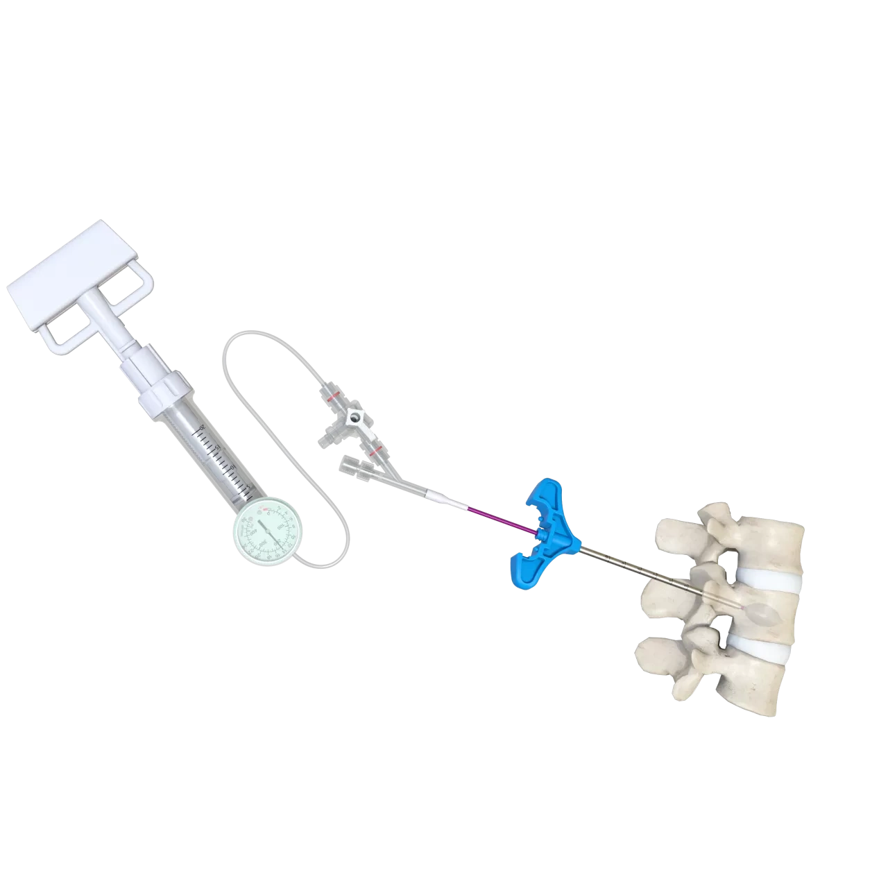 Balloon Kyphoplasty (PKP),Shinvaunited,Balloon Kyphoplasty (PKP)