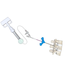 Balloon Kyphoplasty (PKP),Shinvaunited,Balloon Kyphoplasty (PKP)