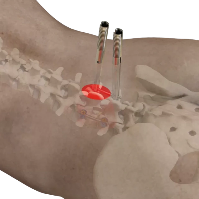 CoCrMo MIS Percutaneous System 5.5/6.0,Shinvaunited,CoCrMo MIS Percutaneous System 5.5/6.0