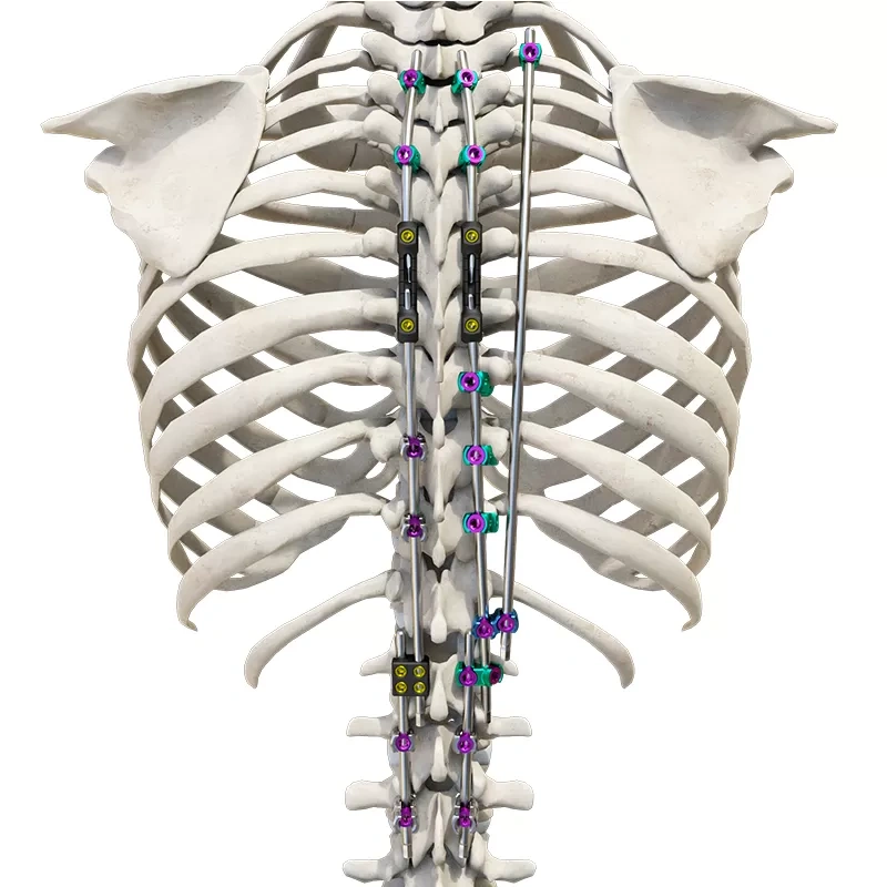 CoCrMo Posterior Thoracolumbar Spinal System 4.5(for children),Shinvaunited,CoCrMo Posterior Thoracolumbar Spinal System 4.5(for children)