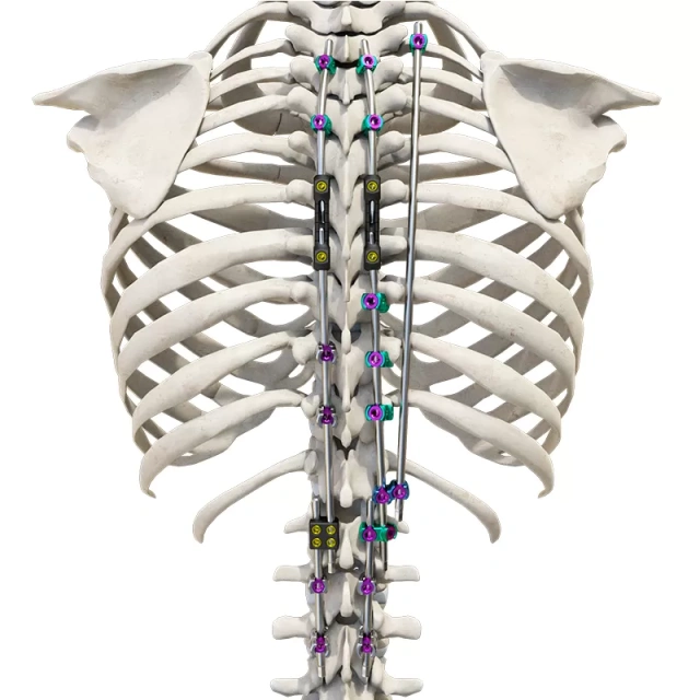 CoCrMo Posterior Thoracolumbar Spinal System 4.5(for children),Shinvaunited,CoCrMo Posterior Thoracolumbar Spinal System 4.5(for children)