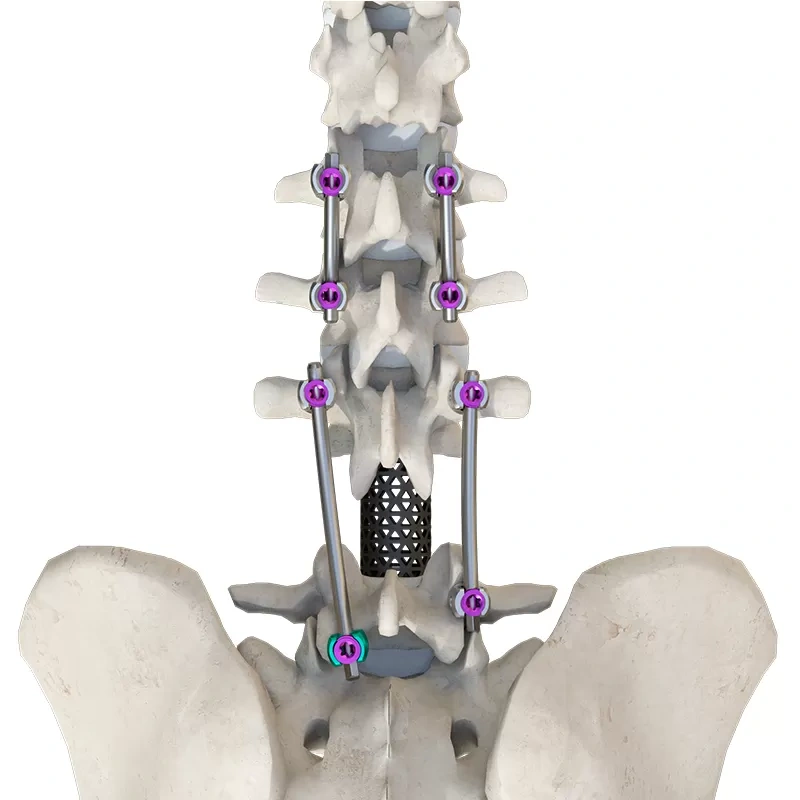 CoCrMo Posterior Thoracolumbar Spinal System 4.5(for children),Shinvaunited,CoCrMo Posterior Thoracolumbar Spinal System 4.5(for children)