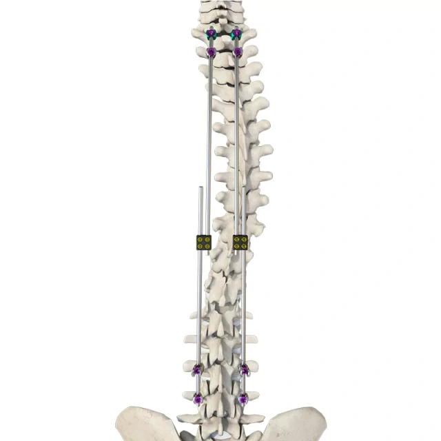 CoCrMo Posterior Thoracolumbar Spinal System 4.5(for children),Shinvaunited,CoCrMo Posterior Thoracolumbar Spinal System 4.5(for children)