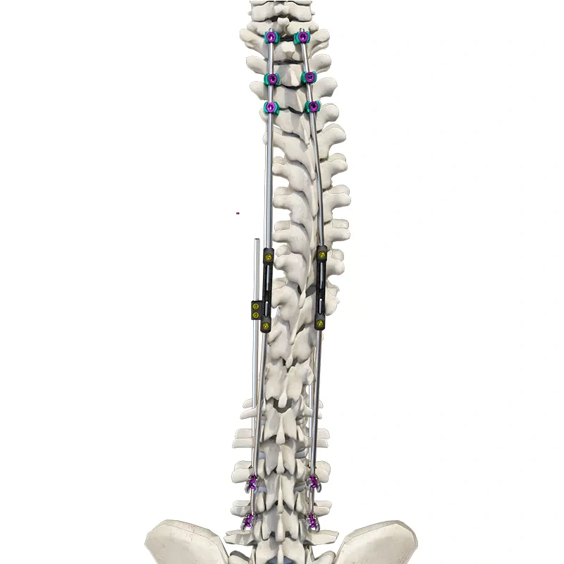 CoCrMo Posterior Thoracolumbar Spinal System 4.5(for children),Shinvaunited,CoCrMo Posterior Thoracolumbar Spinal System 4.5(for children)