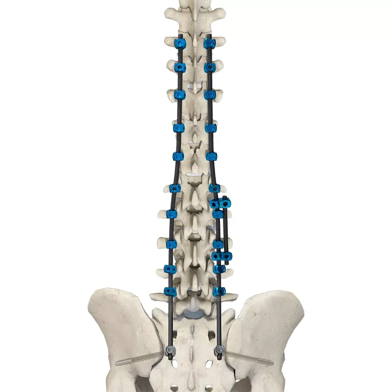 CoCrMo Thoracolumbar Posterior Pedicle Screw and Rod System 4.75,Shinvaunited,CoCrMo Thoracolumbar Posterior Pedicle Screw and Rod System 4.75