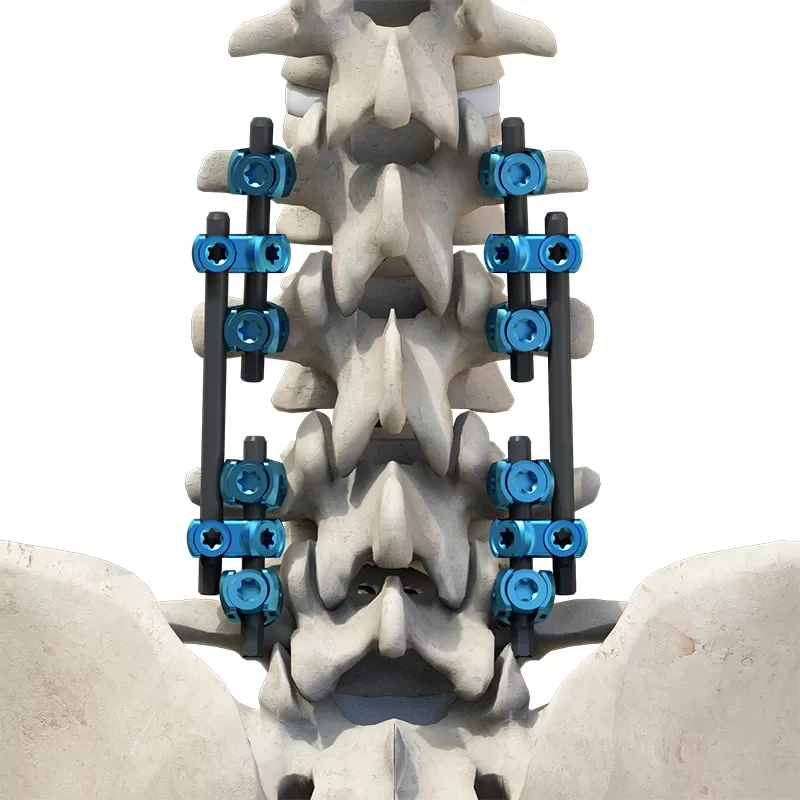 CoCrMo Thoracolumbar Posterior Pedicle Screw and Rod System 4.75,Shinvaunited,CoCrMo Thoracolumbar Posterior Pedicle Screw and Rod System 4.75