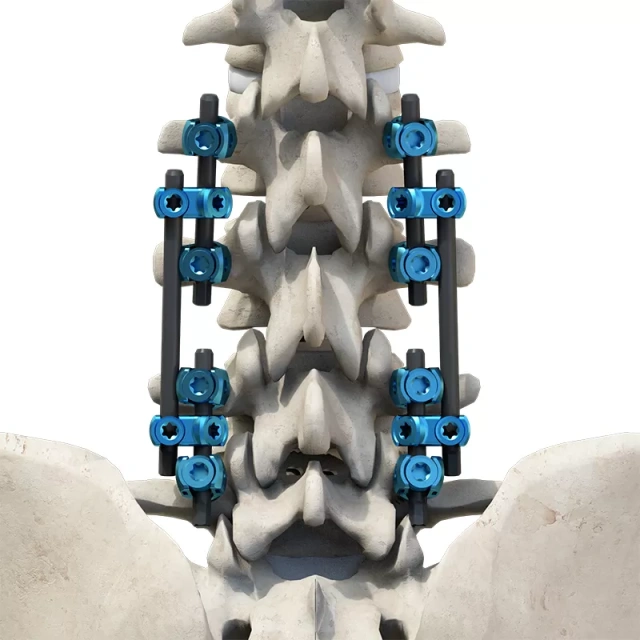 CoCrMo Thoracolumbar Posterior Pedicle Screw and Rod System 4.75,Shinvaunited,CoCrMo Thoracolumbar Posterior Pedicle Screw and Rod System 4.75