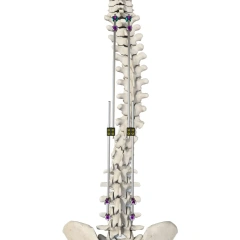 CoCrMo Thoracolumbar Posterior Pedicle Screw and Rod System 4.75,Shinvaunited,CoCrMo Thoracolumbar Posterior Pedicle Screw and Rod System 4.75