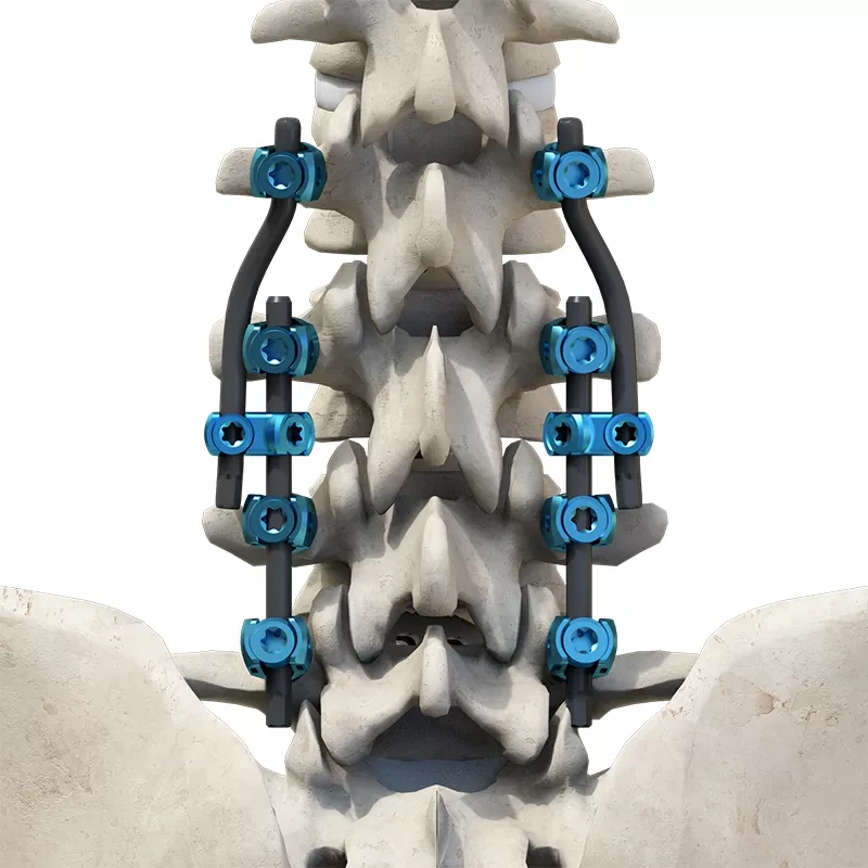 CoCrMo Thoracolumbar Posterior Pedicle Screw and Rod System 5.5/6.0,Shinvaunited,CoCrMo Thoracolumbar Posterior Pedicle Screw and Rod System 5.5/6.0