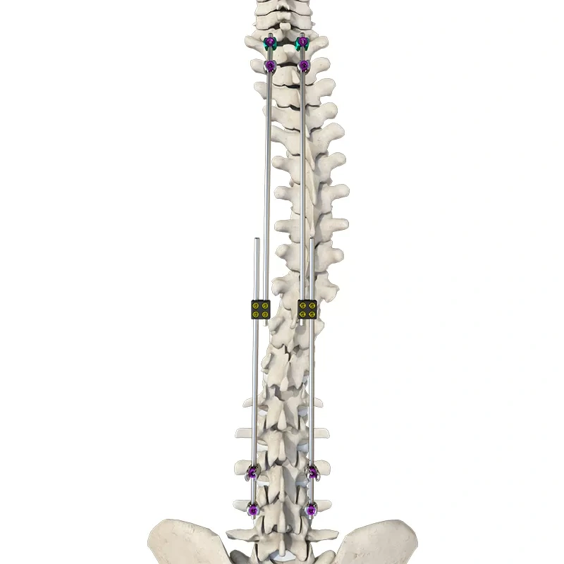CoCrMo Thoracolumbar Posterior Pedicle Screw and Rod System 5.5/6.0,Shinvaunited,CoCrMo Thoracolumbar Posterior Pedicle Screw and Rod System 5.5/6.0