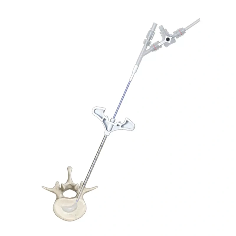 Curved Balloon Kyphoplasty (PCKP),Shinvaunited,Curved Balloon Kyphoplasty (PCKP)
