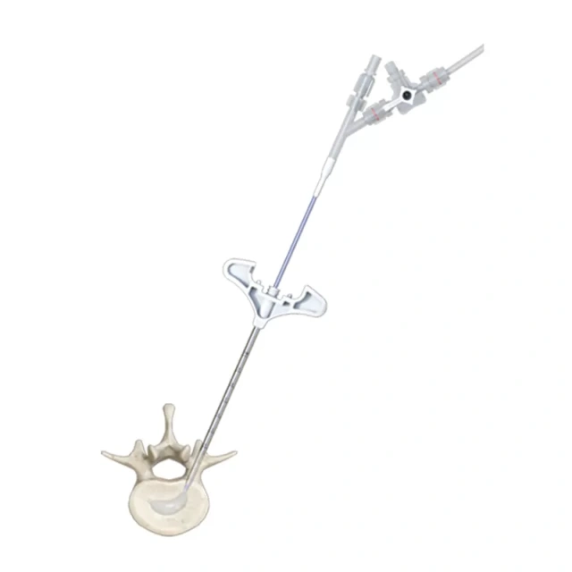 Curved Balloon Kyphoplasty (PCKP),Shinvaunited,Curved Balloon Kyphoplasty (PCKP)